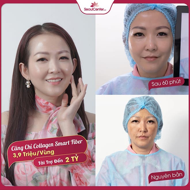 Giải mã sức hút của căng chỉ Collagen Smart Fiber 2021